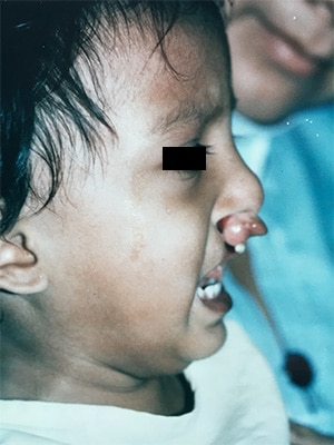 bilateral cleft lip patient 1 before left
