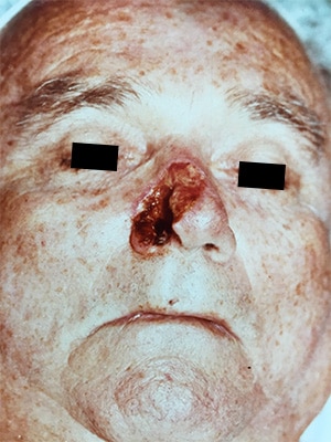 nasal reconstruction patient 4 before
