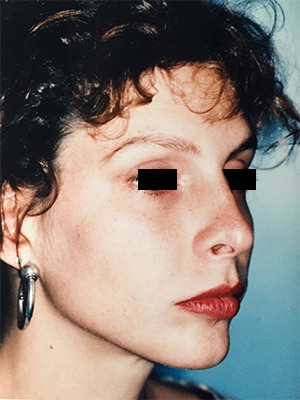 rhinoplasty patient 1 after right