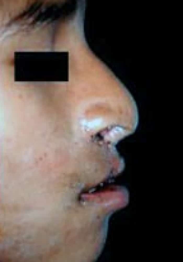 Bilateral Cleft Lip – Case 1