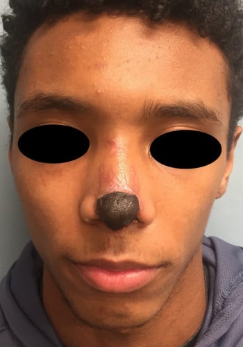 Nasal Reconstruction