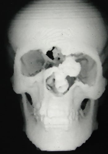Craniofacial Tumor