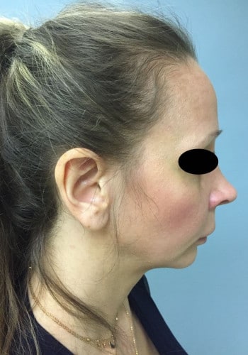 Facial Bone Augmentation;Genioplasty;Browlift