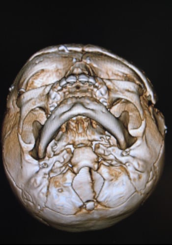 Craniosynostosis