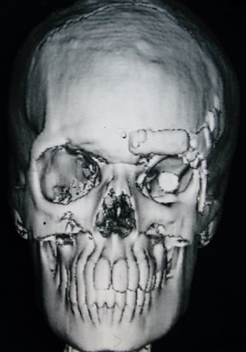 Craniofacial Tumor